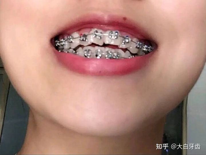 2022年成都十大牙齿矫正医院排名，成都牙齿矫正哪里性价比最高？成都牙齿矫正价格表！(图3)